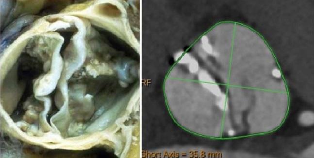 Similar Mortality, Higher Early Stroke Risks in TAVR for